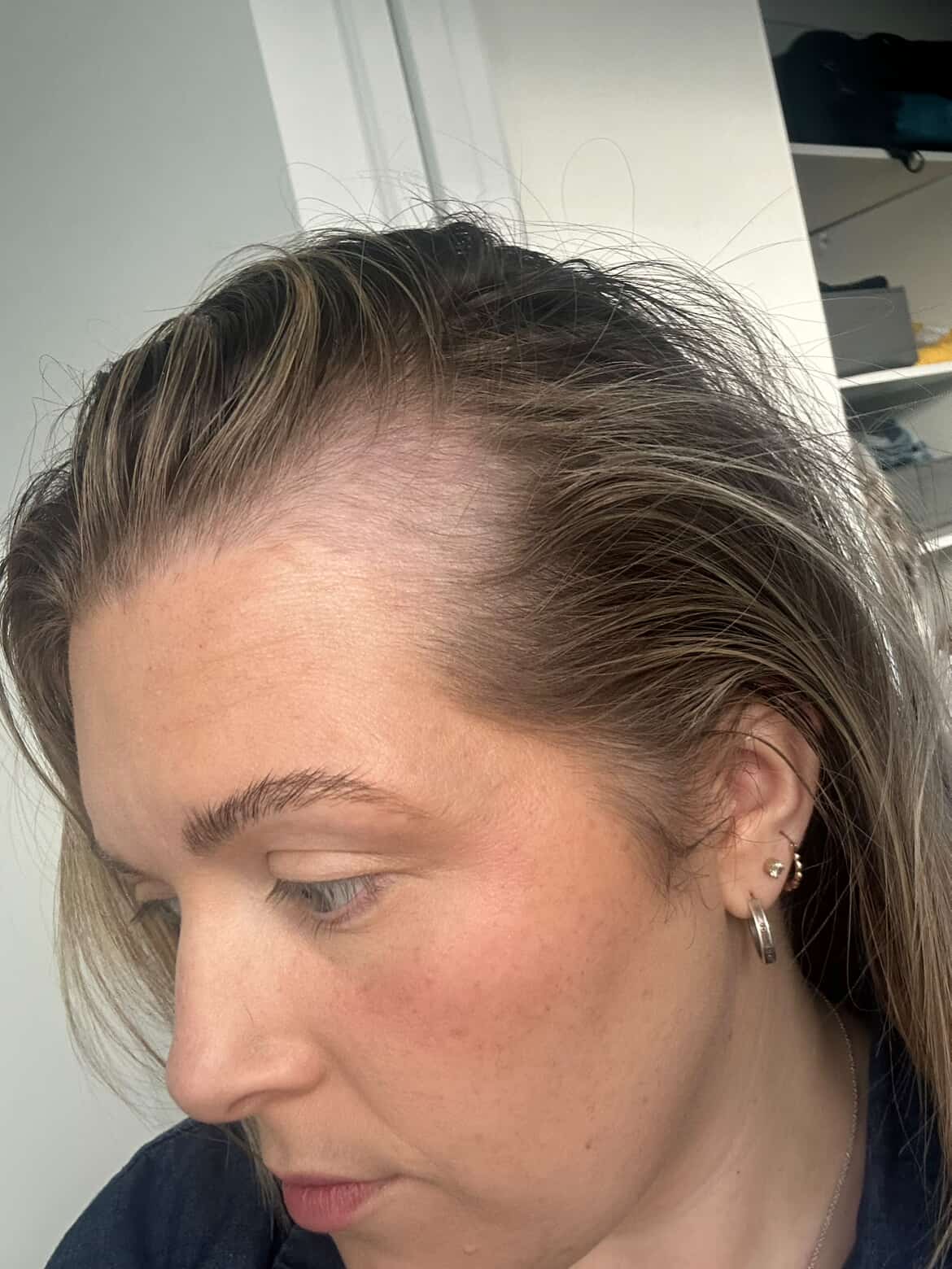 Rebirth Hair Growth System