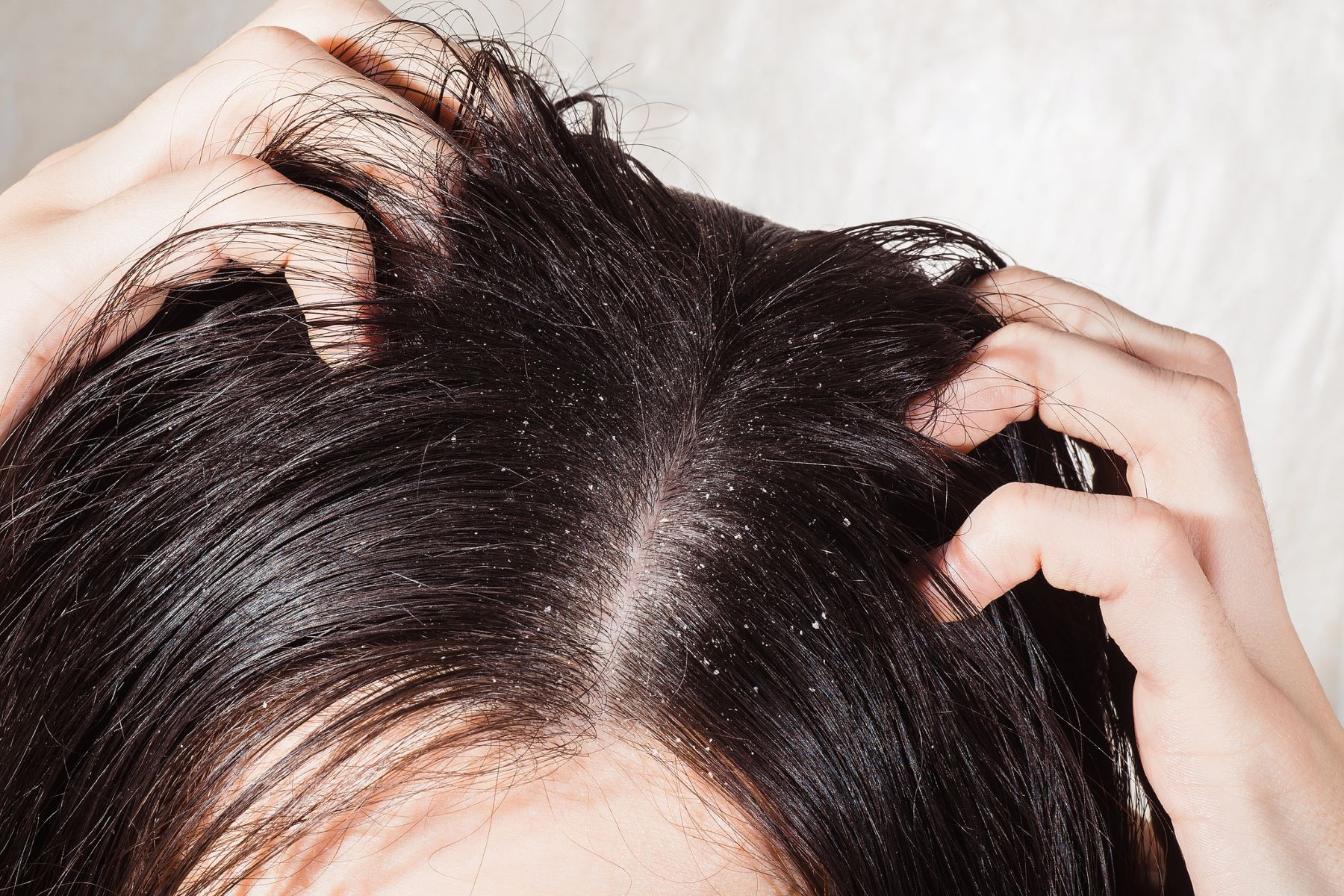 what causes dry & flakey scalp?